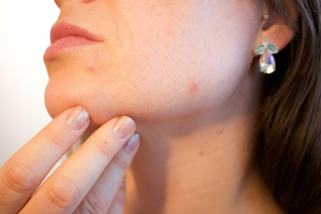 Comment identifier acné kystique ?
