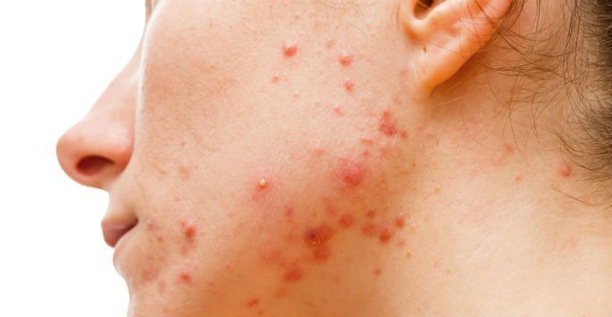 acné inflammatoire causes