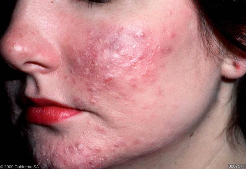 Couperose et acné rosacée causes 