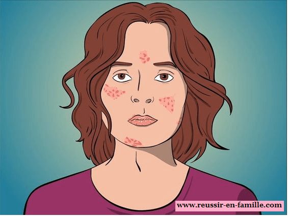 concombre contre l'acné visage