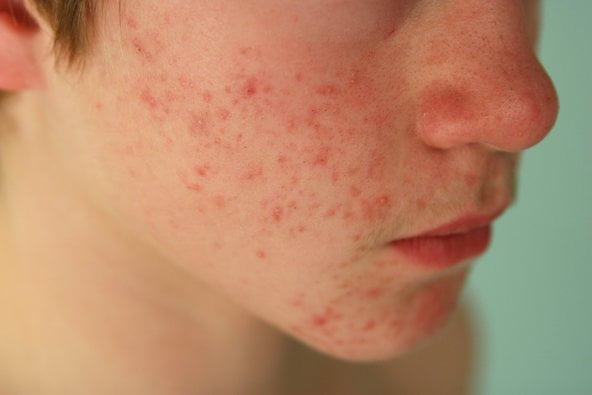 L'acné ménopause est-elle une forme d'acné hormonale ?