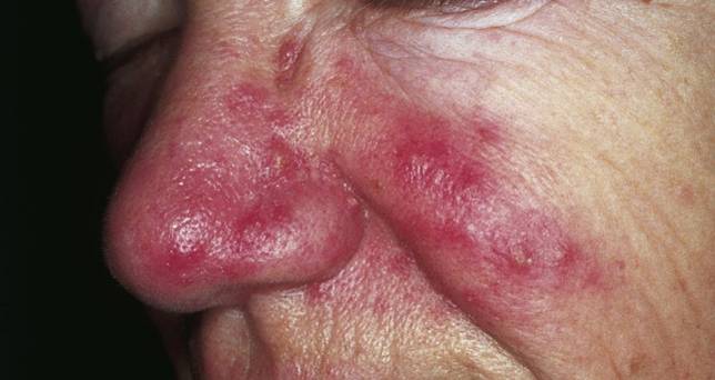 Couperose et acné rosacée symptômes