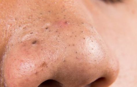 Point noir sur le nez : causes, traitements et remèdes Prévention des comédons sur le nez : routine de nettoyage adaptée