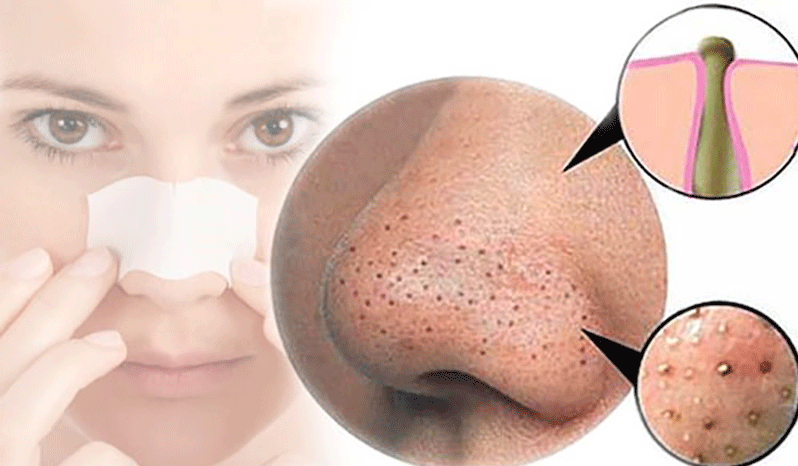 différents types d'acné : points noirs