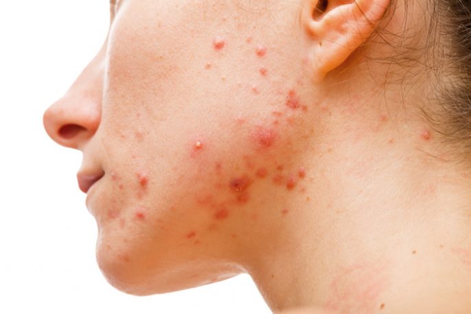 types d'acné : acné kystique